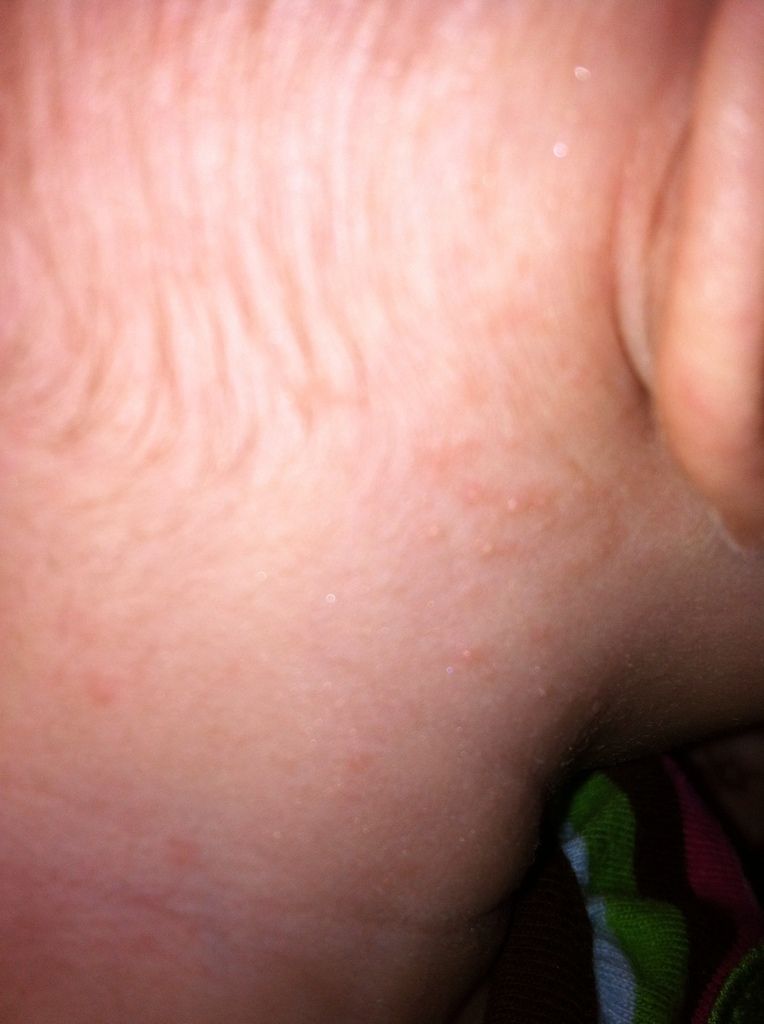 Baby acne or allergic reaction? PIC - BabyCenter