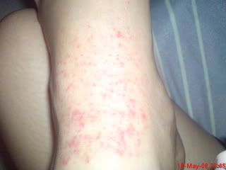 Weird Skin Rash