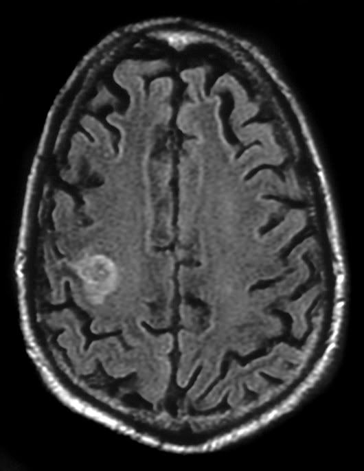 MRI Brain Scan